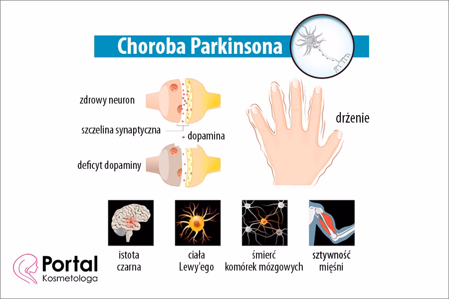 Jak zmniejszyć napięcie mięśniowe w chorobie Parkinsona?