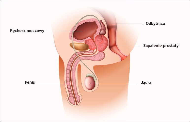 Czy przy prostacie staje?
