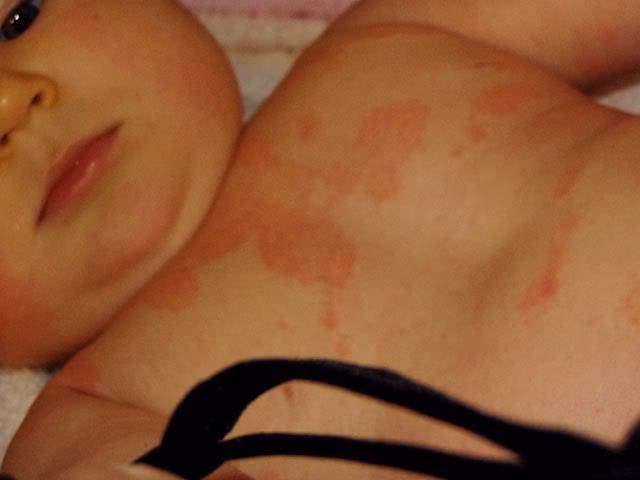 Co oznaczają czerwone plamki u niemowlaka?