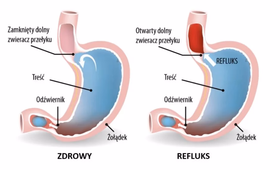 Dlaczego nie można palić przy refluksie?