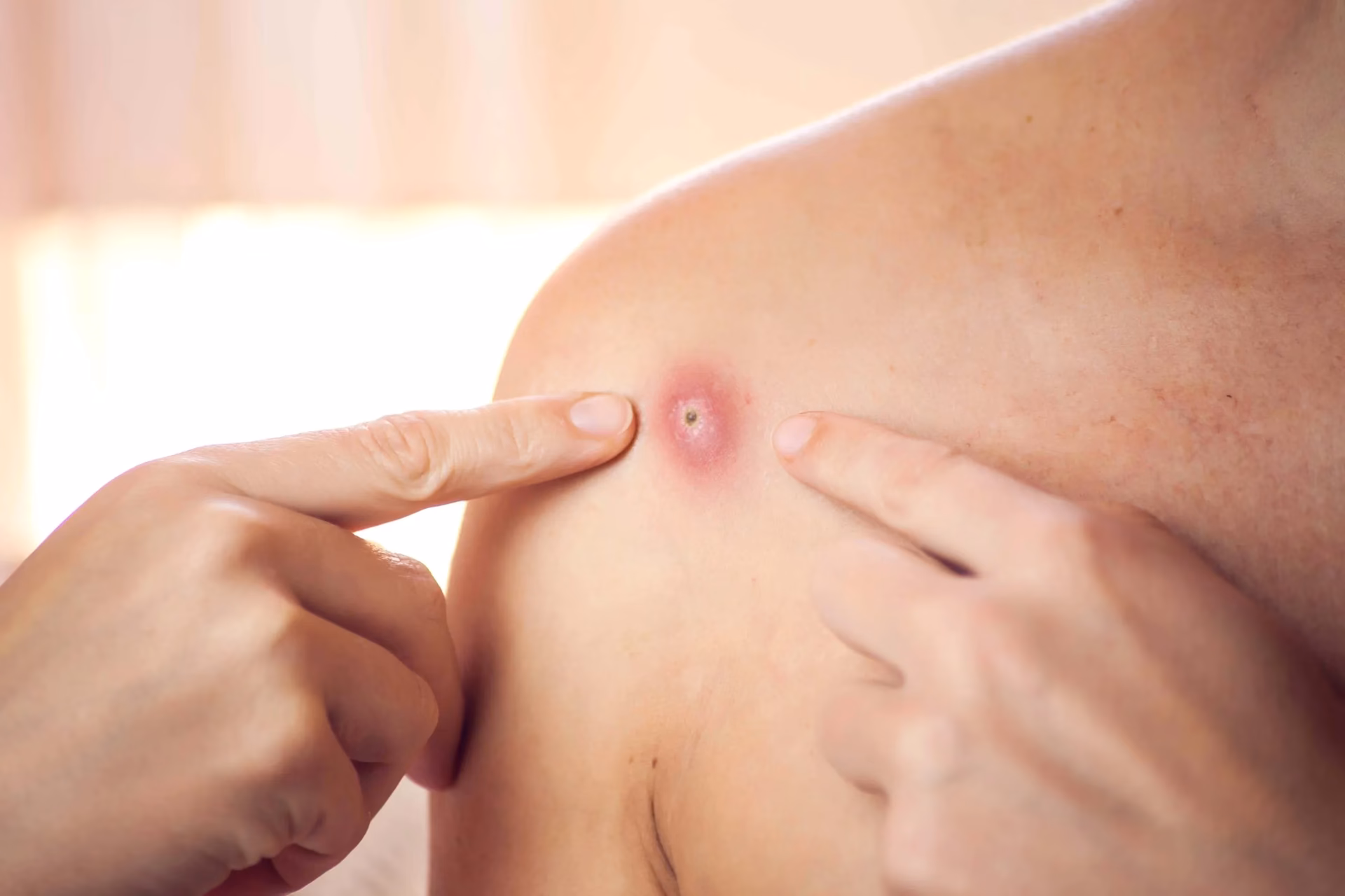 Co jest w środku czyraka?