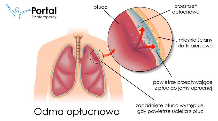 Jak działa odmą płucną?