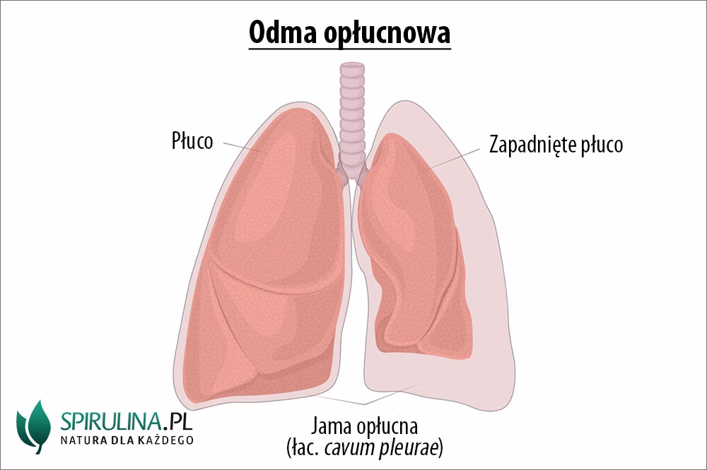 Jaki jest najlepszy sposób wentylacji w przypadku odmy opłucnowej?