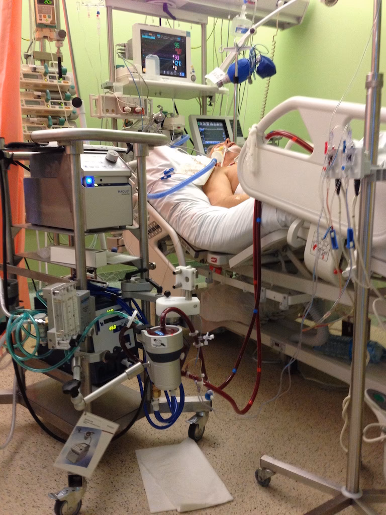 Czy podczas ECMO konieczna jest wentylacja?