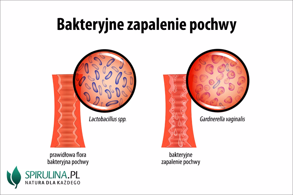 Co zaburza florę bakteryjną pochwy?