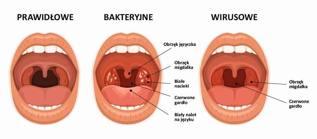 Od czego robi się gula w gardle?