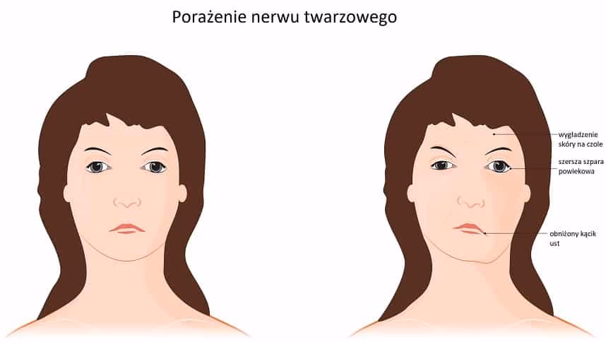 Jak przyspieszyć regenerację nerwu twarzowego?