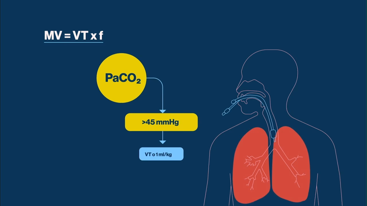 Co oznacza wysoki wskaźnik MVE w przypadku respiratora?